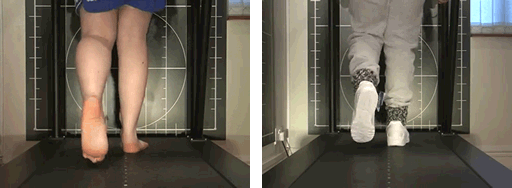 video gait analysis